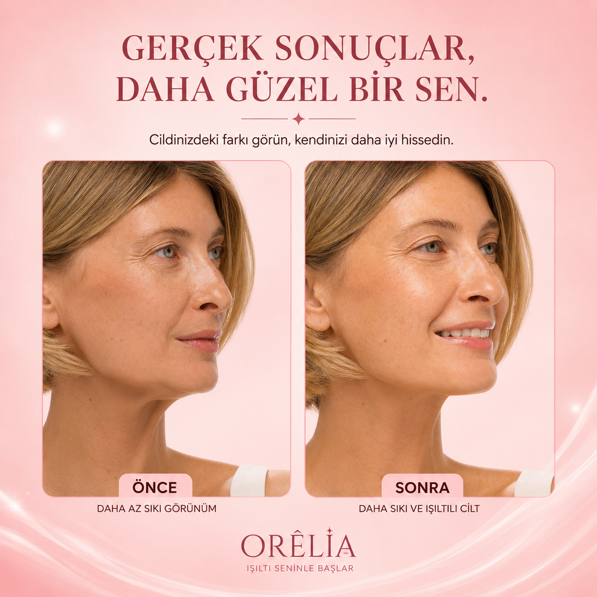 Orélia™ – Çene Hattı ve Boyun İçin Lifting Kolajen Maskesi